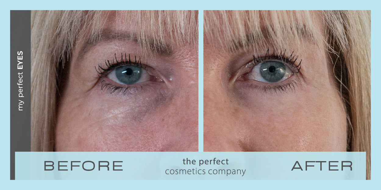 Before and after under eye puffiness, eye bags, fine lines and wrinkles, My Perfect Eyes results, lower eye blepharoplasty alternative