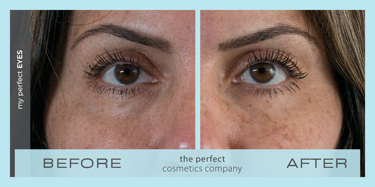 Under eye bags and puffiness before and after using My Perfect Eyes, fine lines and wrinkles, lower eye blepharoplasty alternative