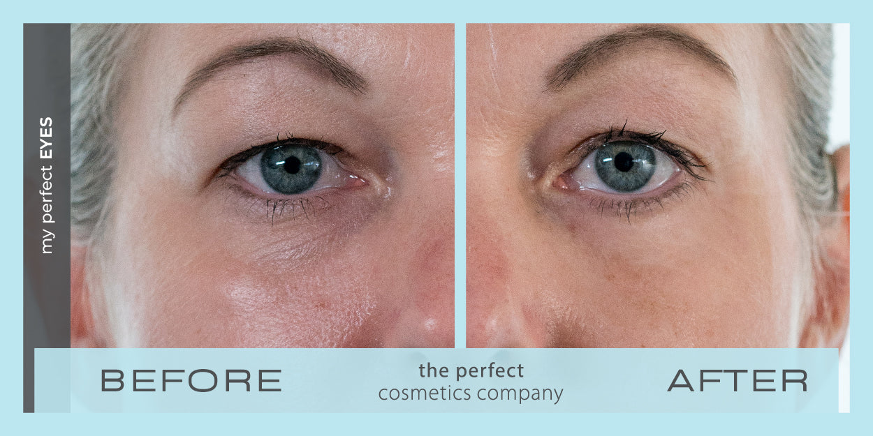 Under eye bags and puffiness before and after using My Perfect Eyes, fine lines and wrinkles, lower eye blepharoplasty alternative