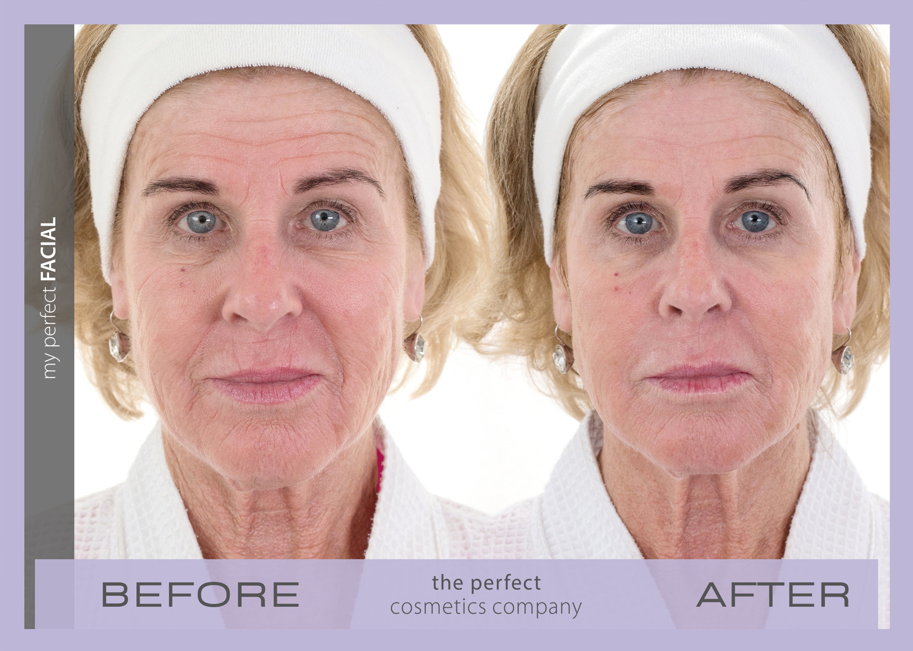 Before and after anti aging facial contouring with My Perfect Facial, smoothing skin texture, softening lines and wrinkles