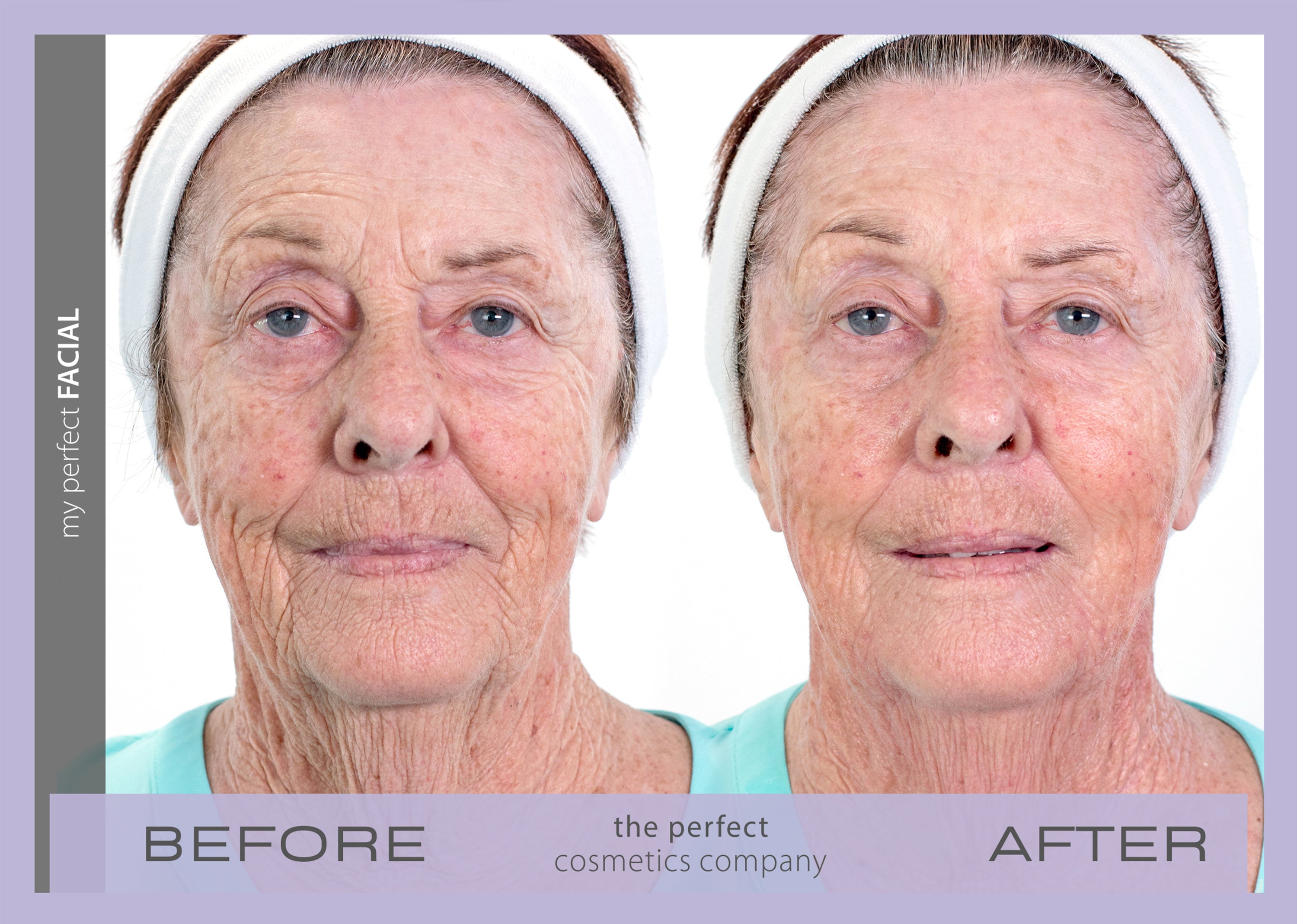 My Perfect Facial results before and after lifting, toning, firming face neck and décolletage for smoother complexion