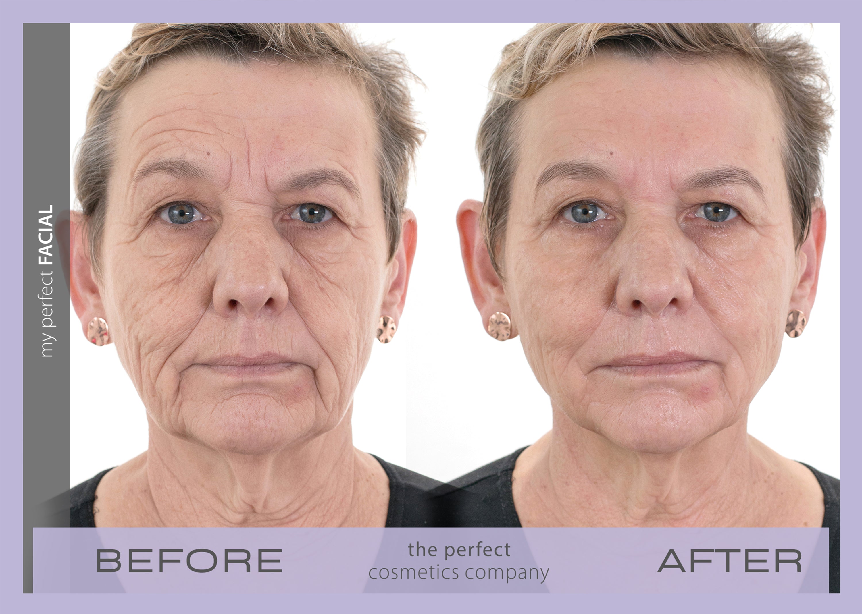 Before and after My Perfect Facial lifting, toning and firming skin, smoothing fine lines and wrinkles, facial contouring treatment